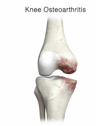 Knee osteoarthritis