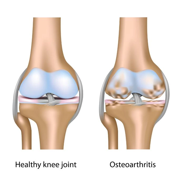 Knee Osteoarthritis Explanation at TheChiro Bukit Jalil