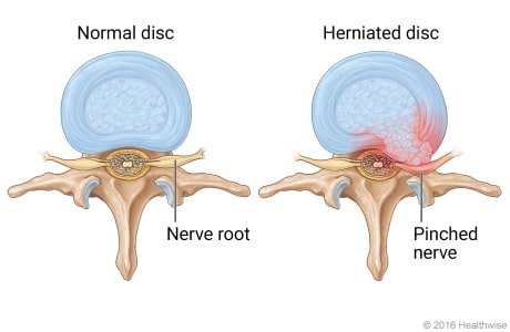 Comparison between a healthy spinal disc and a herniated disc pressing on sciatic nerve, showing how nerve compression occurs