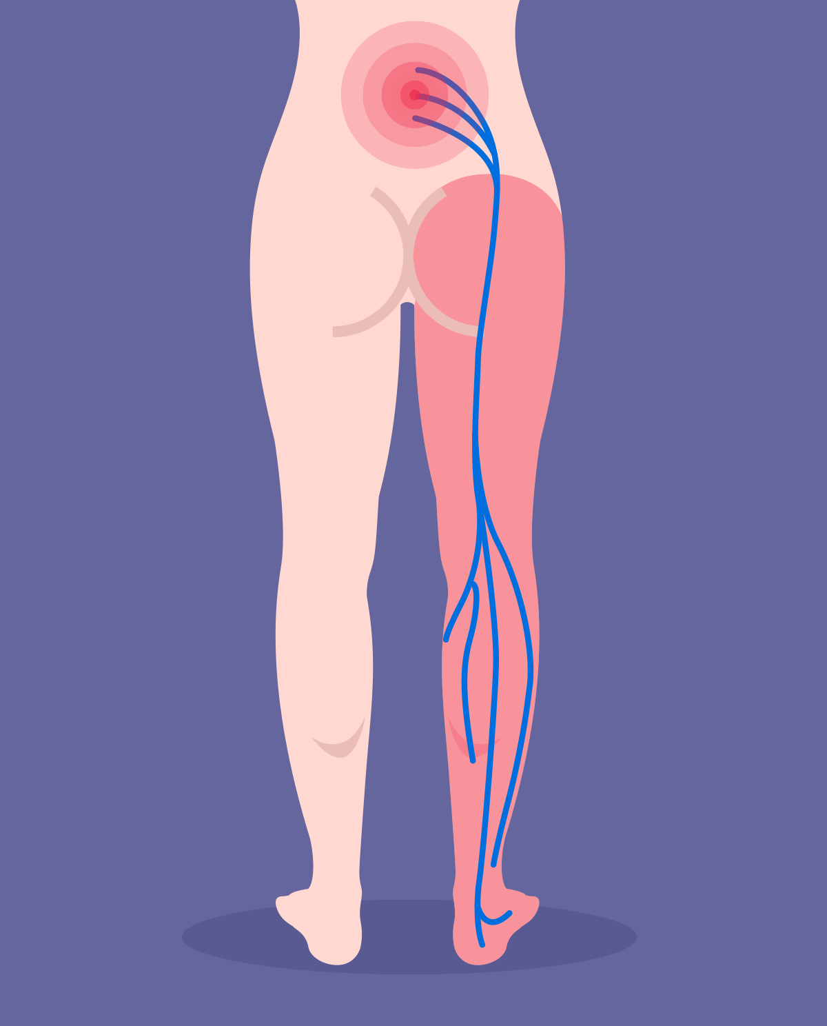 Sciatica Diagram