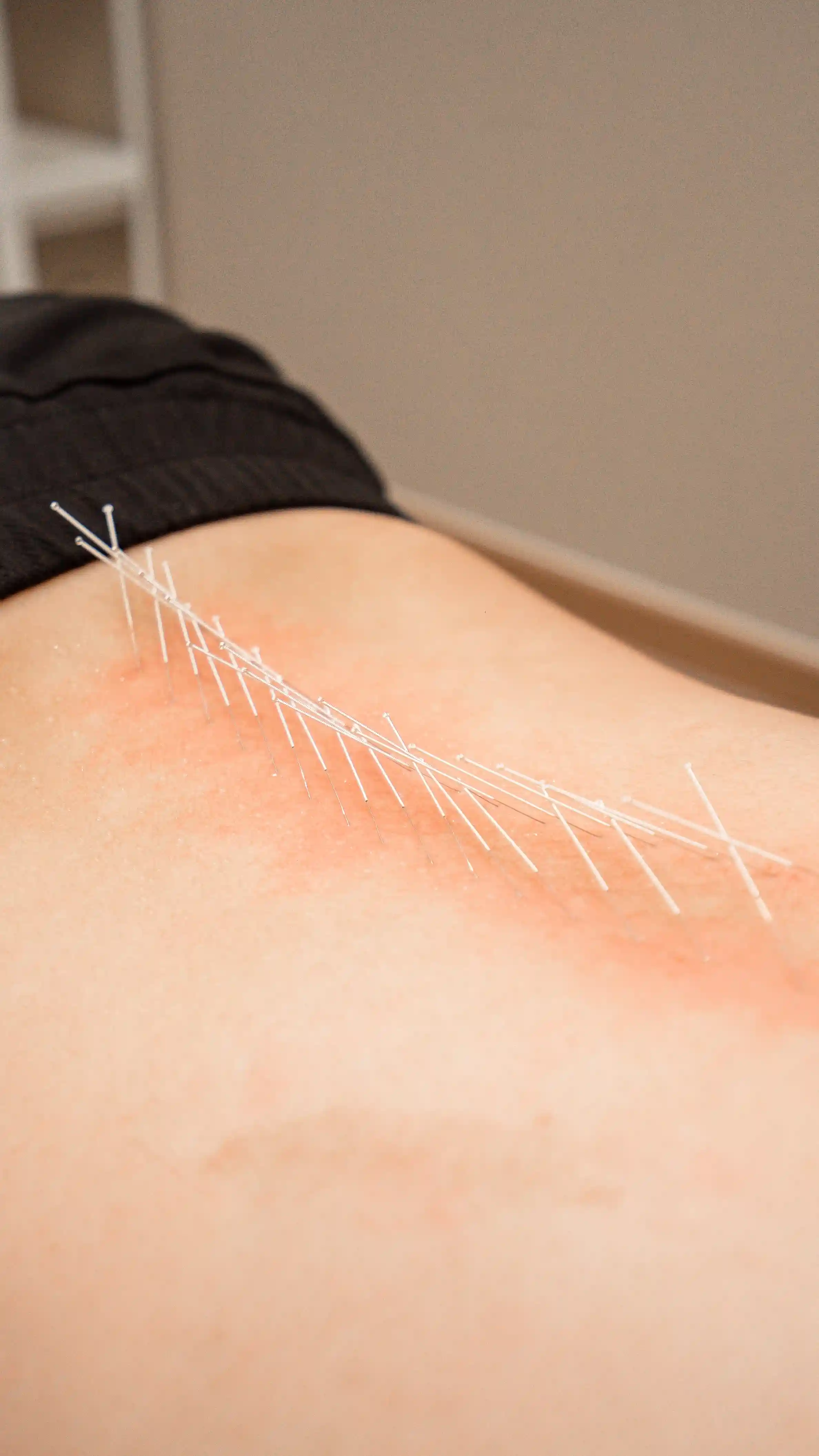 FAM Needling Treatment